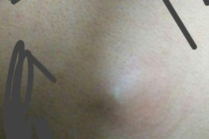 兔子脚后跟硬块的症状及治疗方法（了解兔子脚后跟硬块的原因与预防措施）